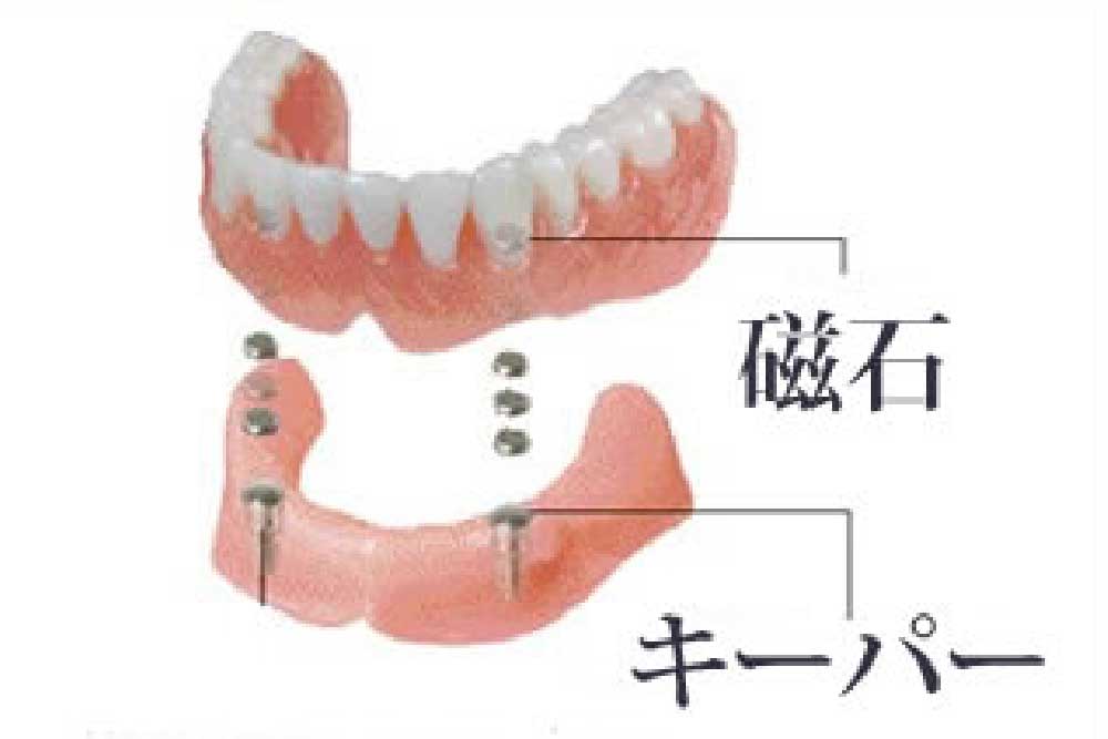 磁性アタッチメント加工